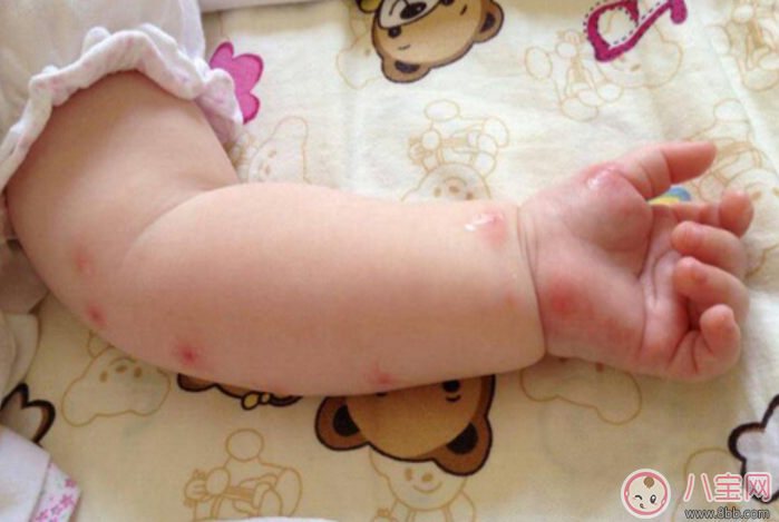 夏天寶寶招蚊子咬怎么辦 蚊子為什么總喜歡咬寶寶 夏天寶寶招蚊子咬怎么辦 蚊子為什么總喜歡咬寶寶