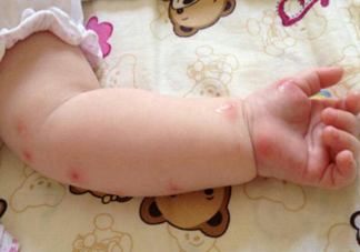 夏天寶寶招蚊子咬怎么辦 蚊子為什么總喜歡咬寶寶