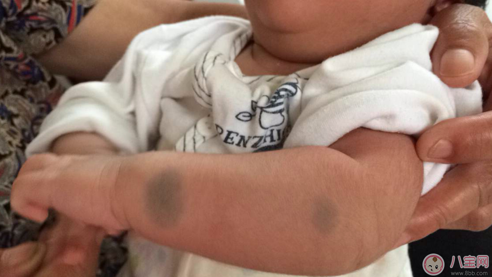 寶寶胎記會(huì)自己掉嗎 寶寶胎記去除方法 寶寶胎記會(huì)自己掉嗎 寶寶胎記去除方法