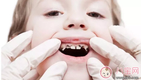寶寶蛀牙不給醫(yī)生看 如何預(yù)防蛀牙減少寶寶痛苦