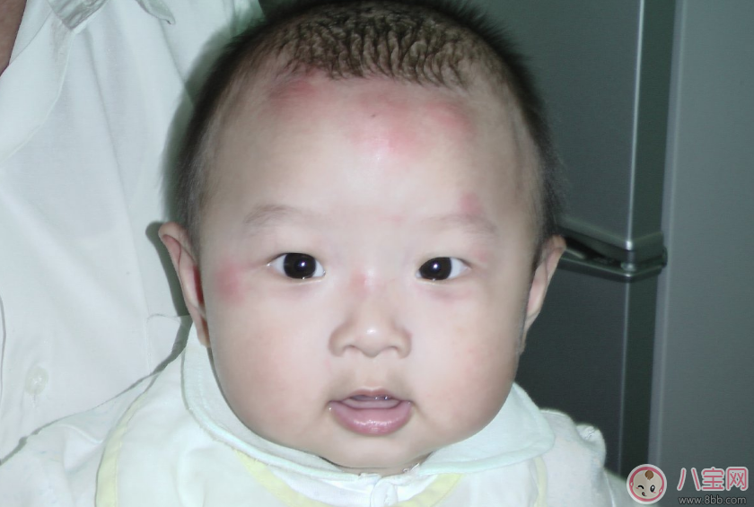 孩子用花露水竟然出現狀況 驅蚊給孩子用什么好