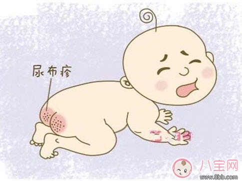 嬰兒長尿布疹怎么辦 尿布疹是怎么引起的
