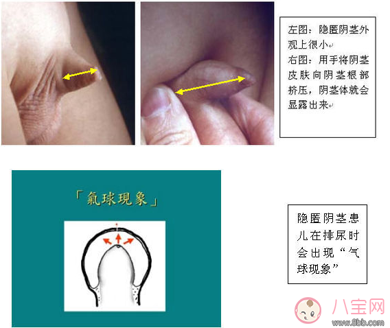 嬰兒陰莖短小 男寶寶下面很小是正常的嗎