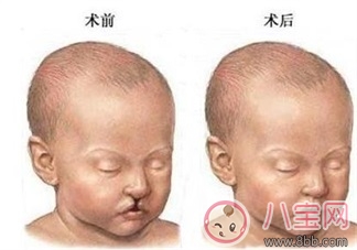 寶寶是兔唇怎么辦    兔唇治得好嗎