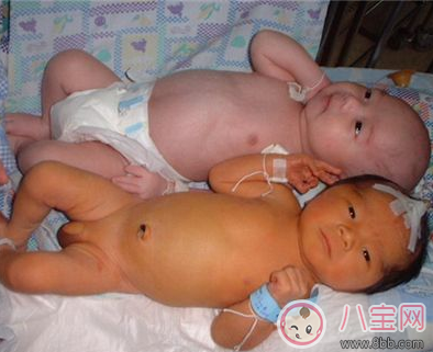 小兒黃疸嚴重嗎    黃疸怎么治