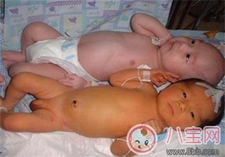 小兒黃疸嚴(yán)重嗎    黃疸怎么治