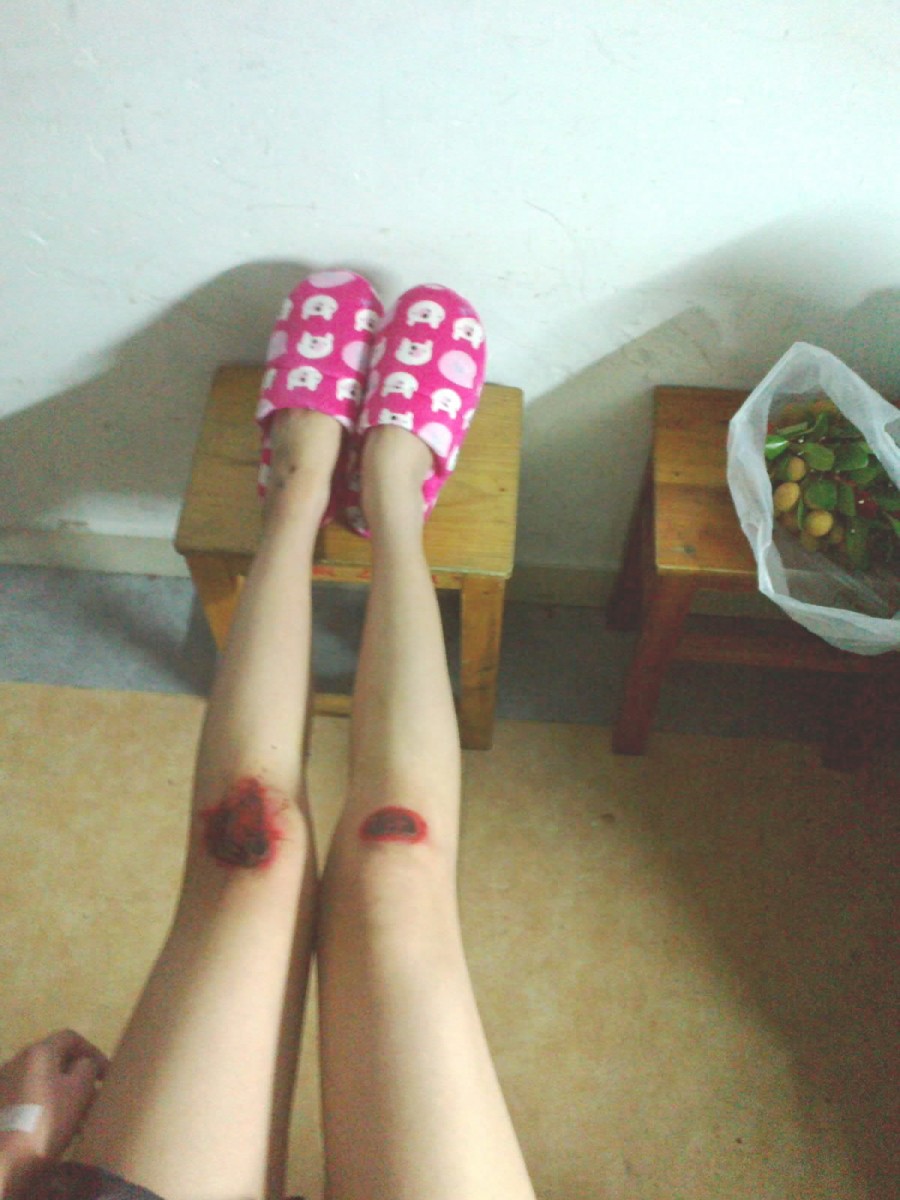 美女膝蓋發(fā)紫了內涵圖