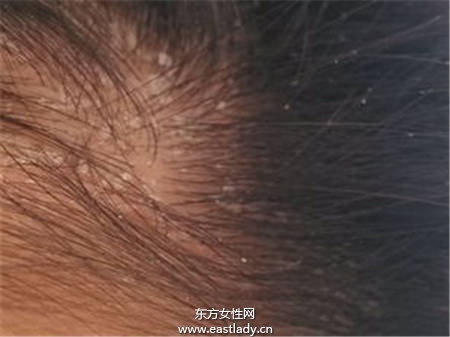 壓力大15歲少女變成 白屑魔女