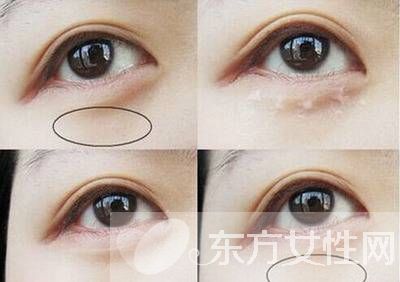 眼部脂肪粒怎么去除 六大方法幫你趕跑脂肪粒