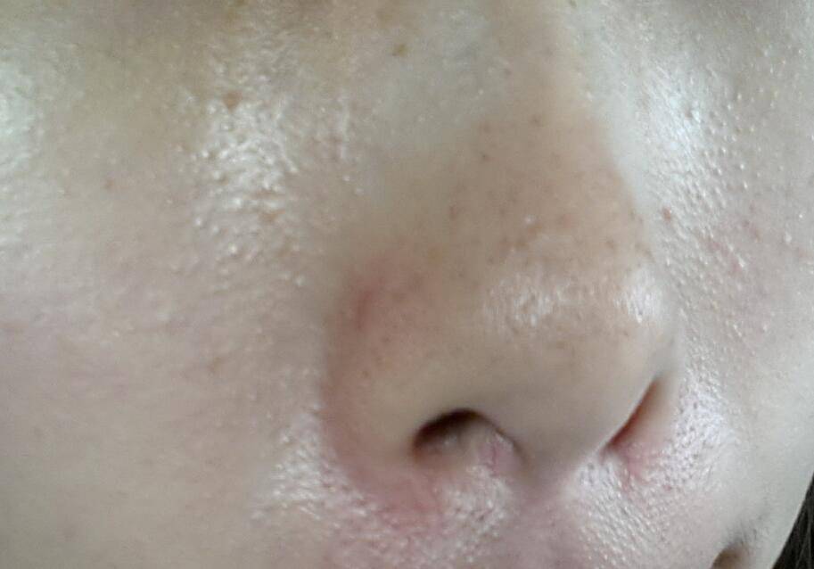 白頭粉刺是怎么形成的 該如何去除