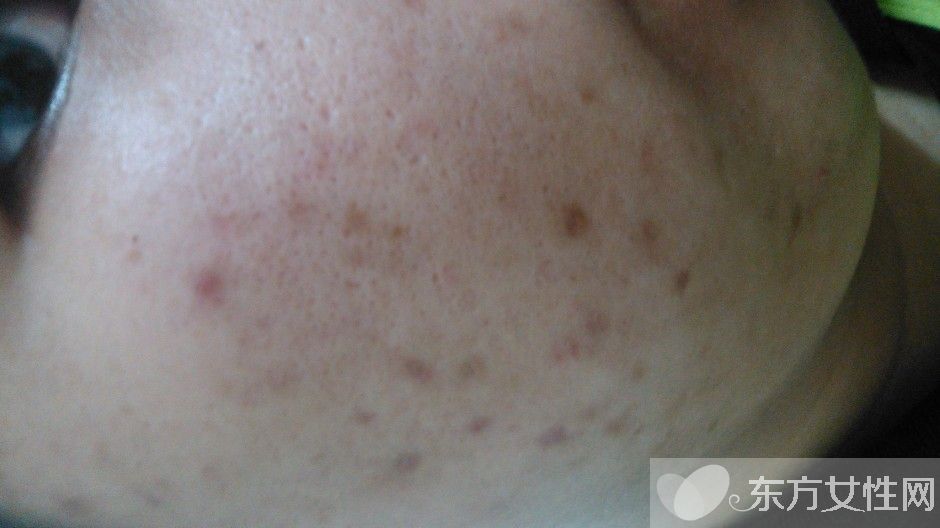 怎么樣去痘疤 痘疤和痘印的區(qū)別