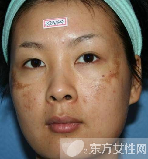 如何有效去除色斑黃褐斑