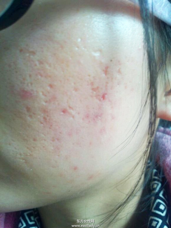 痘坑修復(fù)水能快速的解決痘印問(wèn)題 是真的嗎