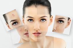 什么可以快速去痘印 8款DIY面膜祛痘美白兩不誤