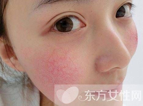 用什么可以去紅血絲 這么做可以快速去除紅血絲哦