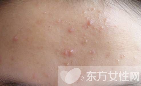 粉刺是怎么形成的 如何有效的去除粉刺