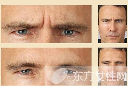 怎樣消除眉間皺紋 四大方法任你選擇