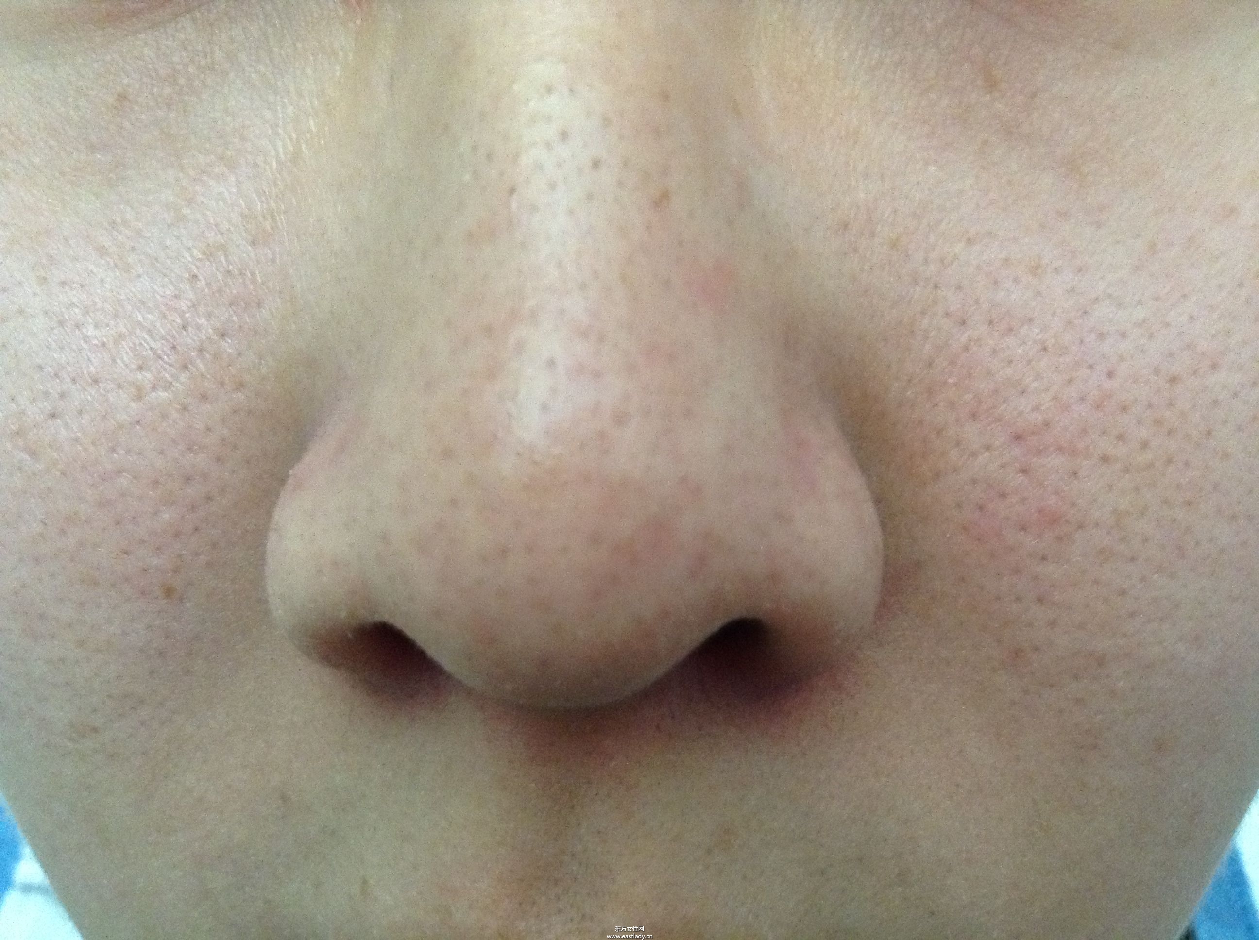 幾個(gè)小訣竅教你怎么去除黑頭粉刺最有效