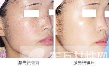 激光祛斑好不好 怎樣祛斑最有效