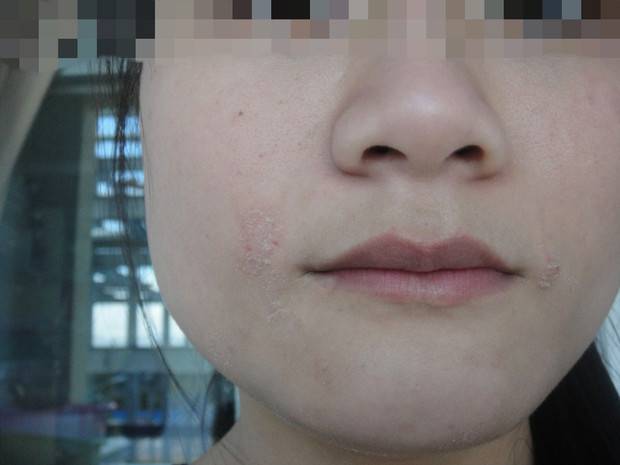 揭密臉上起皮五大原因 四招緩解皮膚干燥