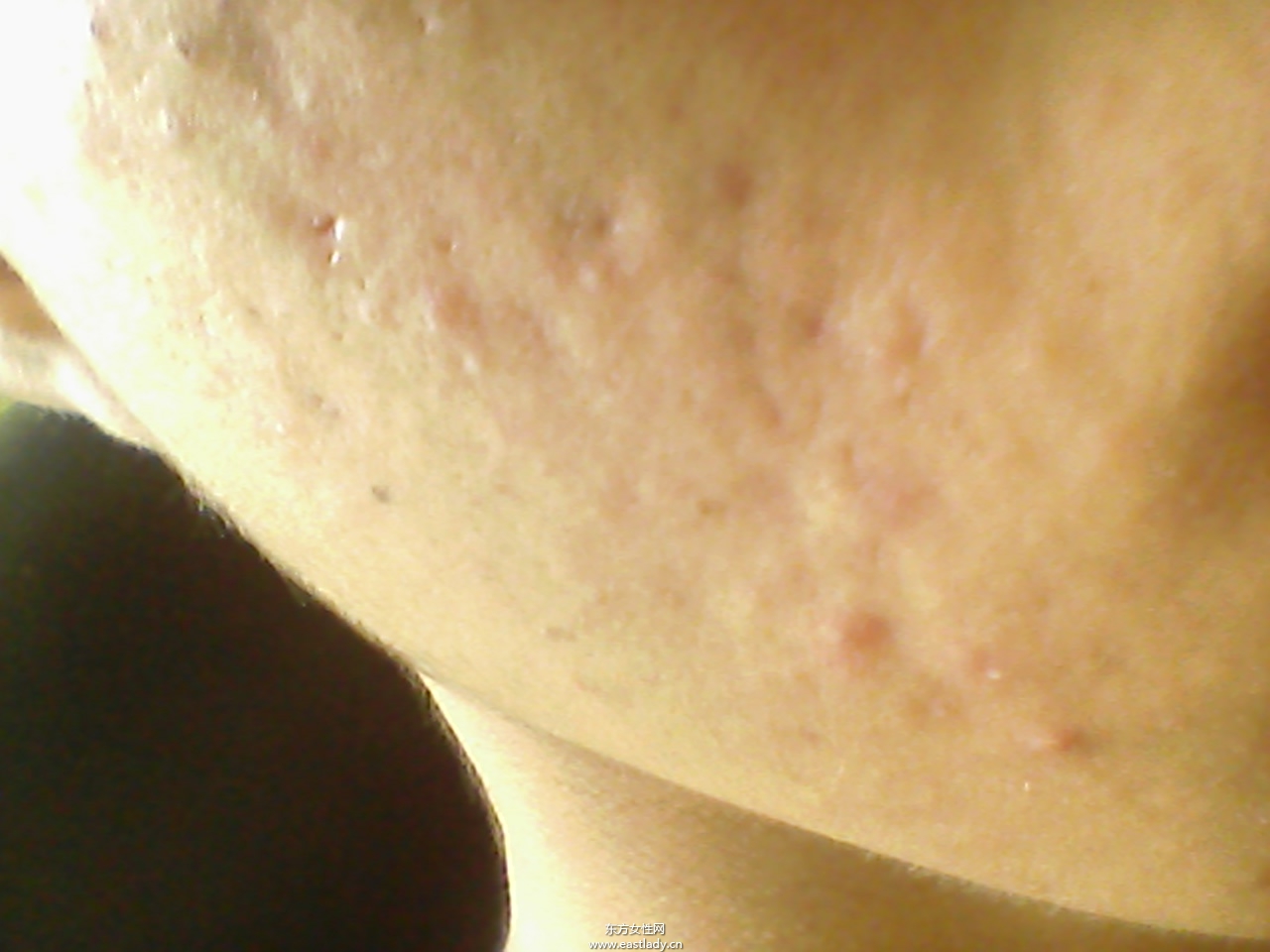 痘坑修復(fù)水能快速的解決痘印問(wèn)題 是真的嗎