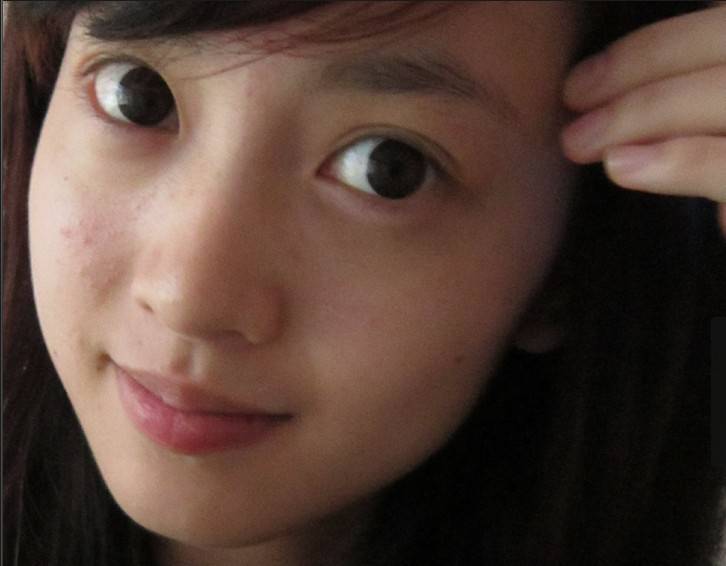 揭右臉長痘痘原因 三小妙招還你白嫩肌膚