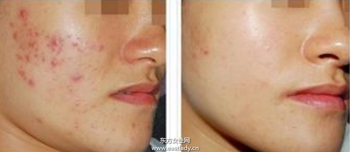 痘坑修復(fù)水能快速的解決痘印問(wèn)題 是真的嗎