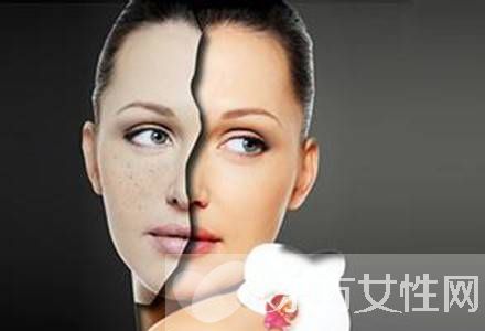 激光祛斑好不好 怎樣祛斑最有效