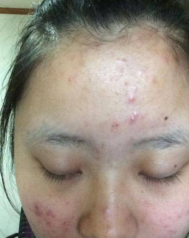 6個(gè)引起痤瘡粉刺的原因 治療痤瘡粉刺偏方推薦