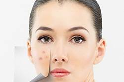 揭右臉長(zhǎng)痘痘原因 三小妙招還你白嫩肌膚