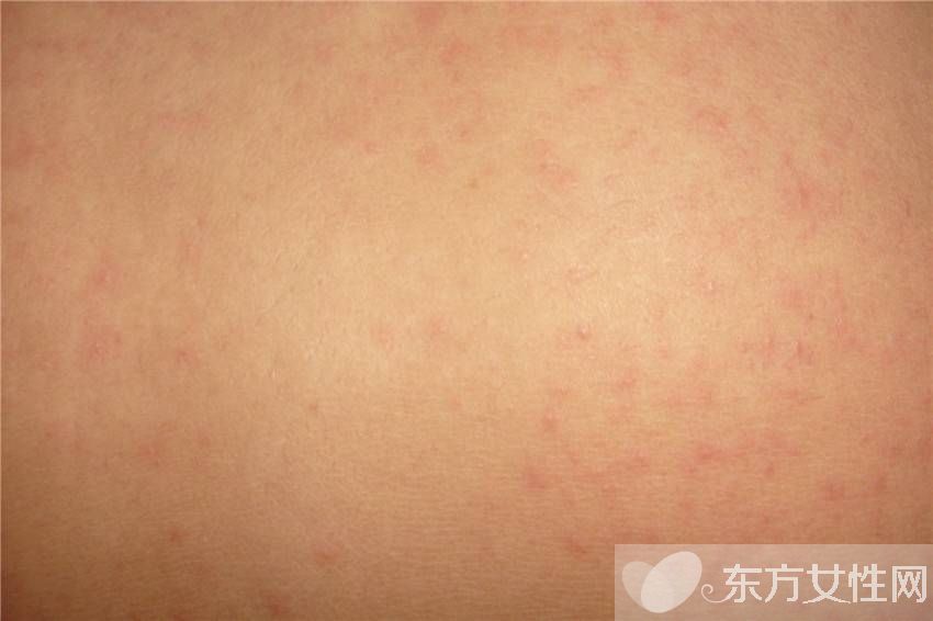 后背上起疙瘩怎么辦 如何防止后背上起疙瘩