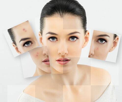 激光祛痘有好有壞 揭密你所不知的副作用