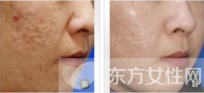 怎么樣去痘疤 痘疤和痘印的區(qū)別