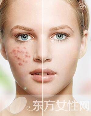祛痘小妙招 只留青春不留痘