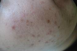 怎么樣去痘疤 痘疤和痘印的區(qū)別