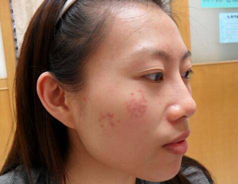 臉頰兩側(cè)長斑的原因 2個小竅門教你如何祛斑