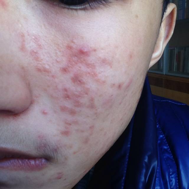 揭右臉長痘痘原因 三小妙招還你白嫩肌膚