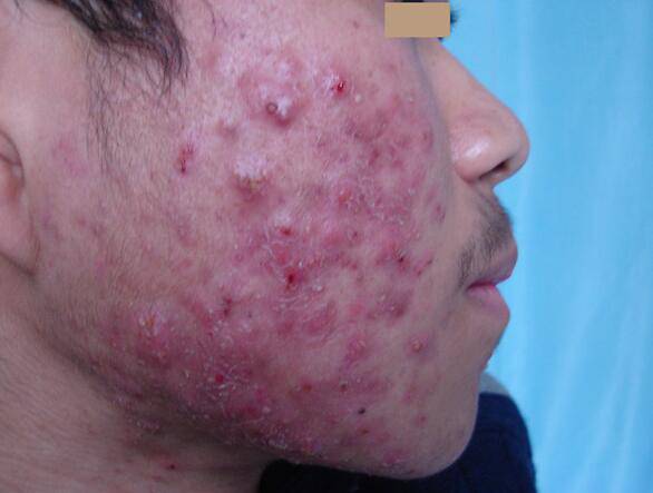 6個(gè)引起痤瘡粉刺的原因 治療痤瘡粉刺偏方推薦