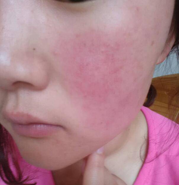 探究紅血絲形成原因 四小妙招去除紅血絲