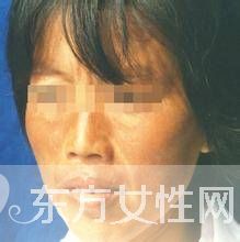 如何有效去除色斑黃褐斑