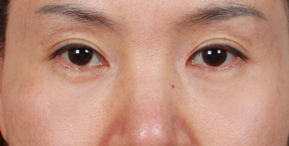 眼部皺紋怎么去除 五種人容易長(zhǎng)皺紋