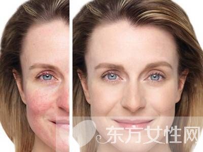 敏感肌膚用什么護膚品？