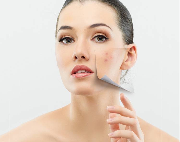 激光祛痘有好有壞 揭密你所不知的副作用