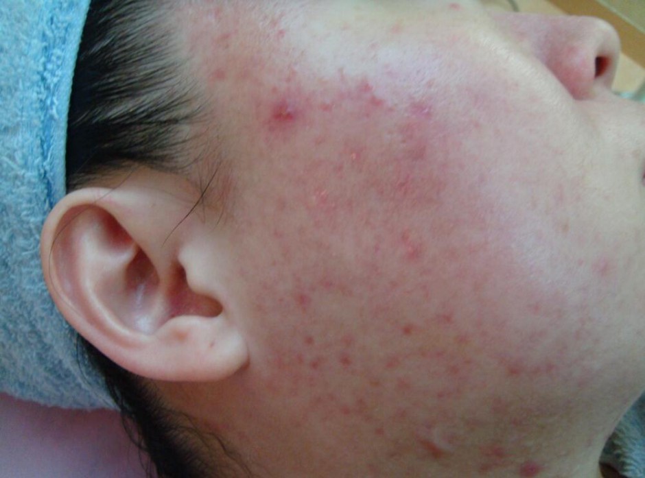 6個(gè)引起痤瘡粉刺的原因 治療痤瘡粉刺偏方推薦