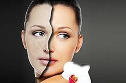 激光祛斑好不好 怎樣祛斑最有效