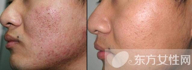 怎么樣去痘疤 痘疤和痘印的區(qū)別