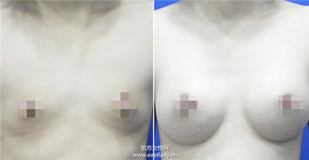 內(nèi)視鏡隆乳平胸女孩的福音