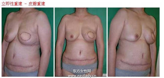 乳腺癌患者乳房重建 重塑女人魅力