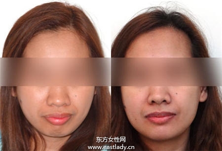 暴牙可以矯正嗎 矯正后可以瘦臉嗎