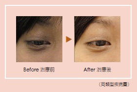 中藥＋針灸去黑眼圈效果更好